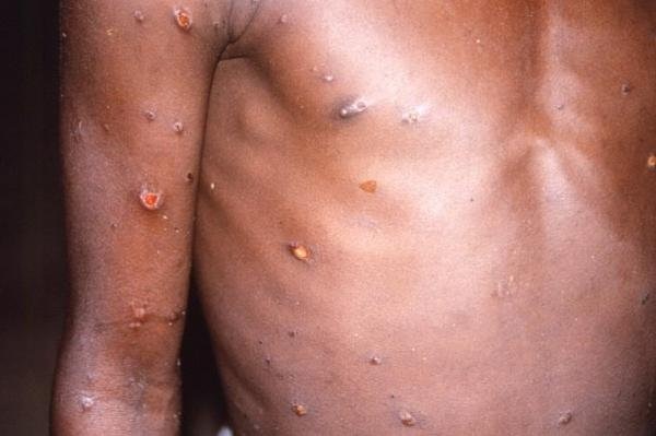 猴痘引起皮肤疱疹